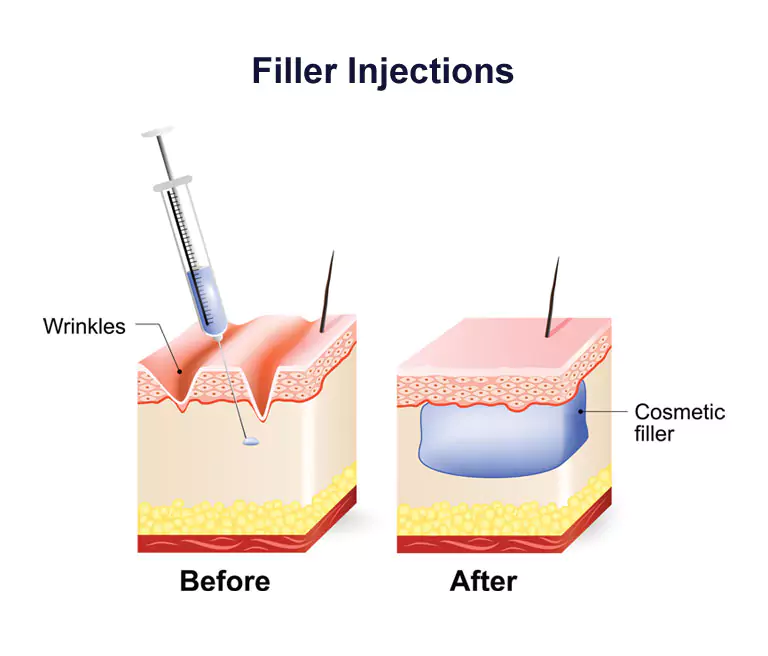 Filler Injection