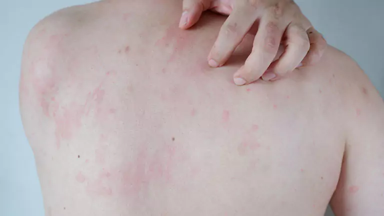 Treatment of allergic patches