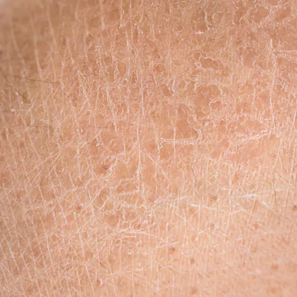 Dry skin conditions