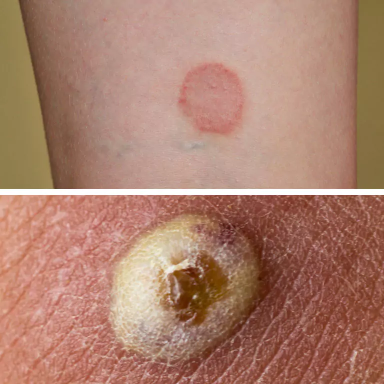 Treatment of skin infections